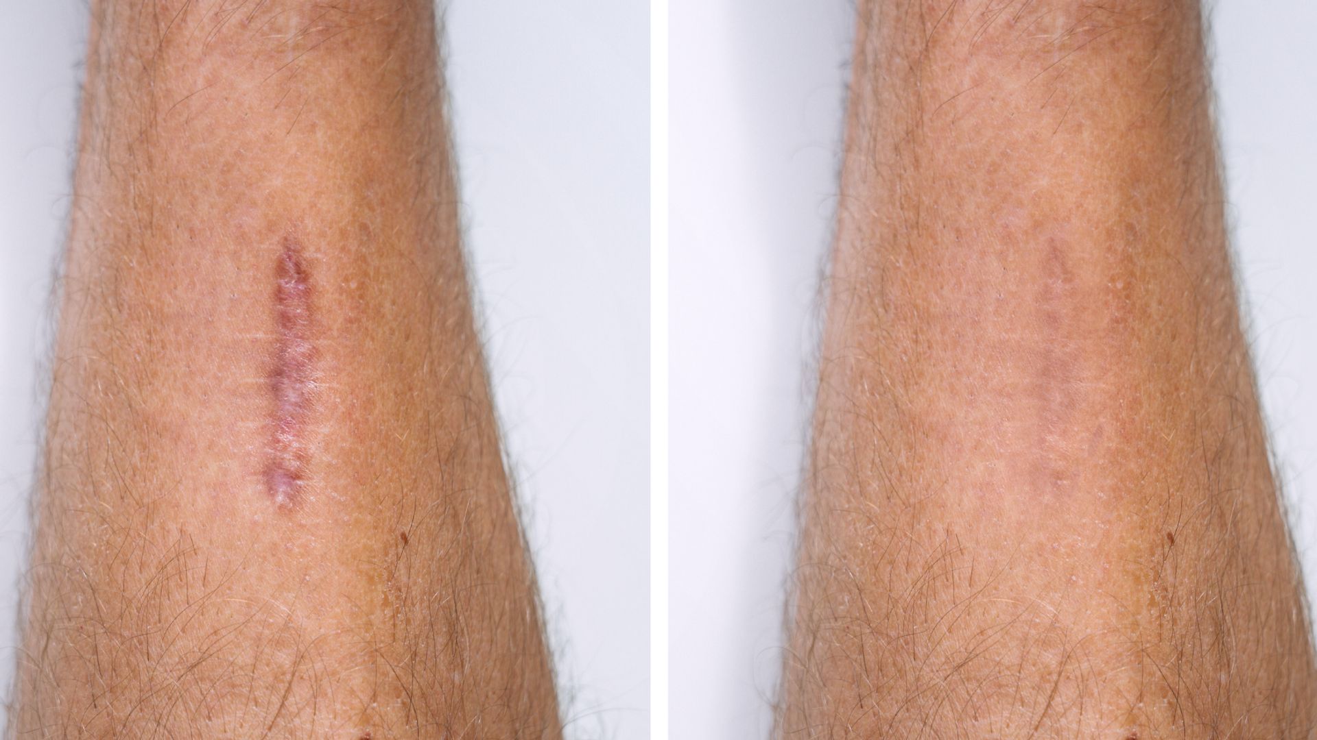Leg with scar side by side, right side shows healed scar