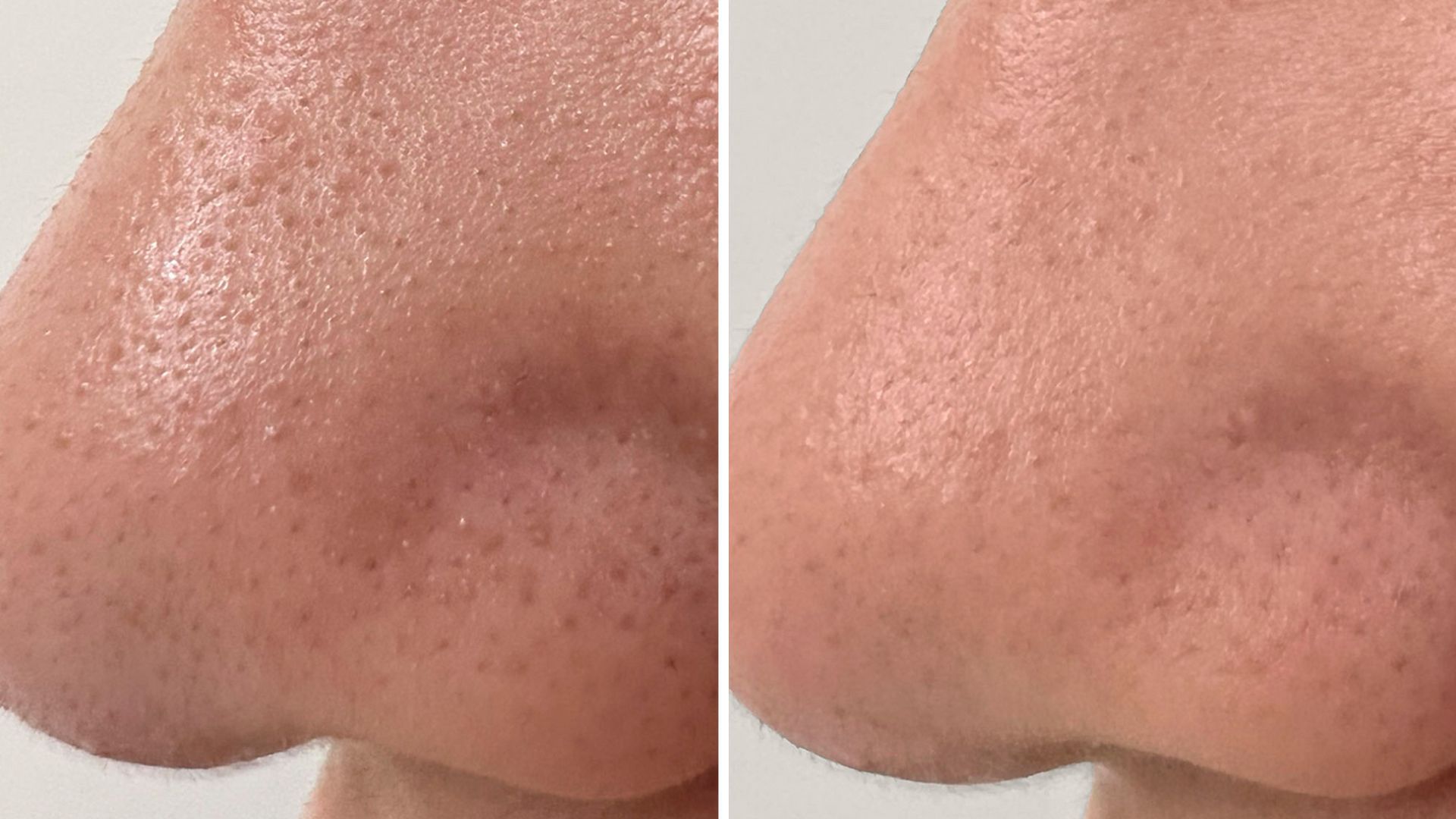 glofacial before and after pores