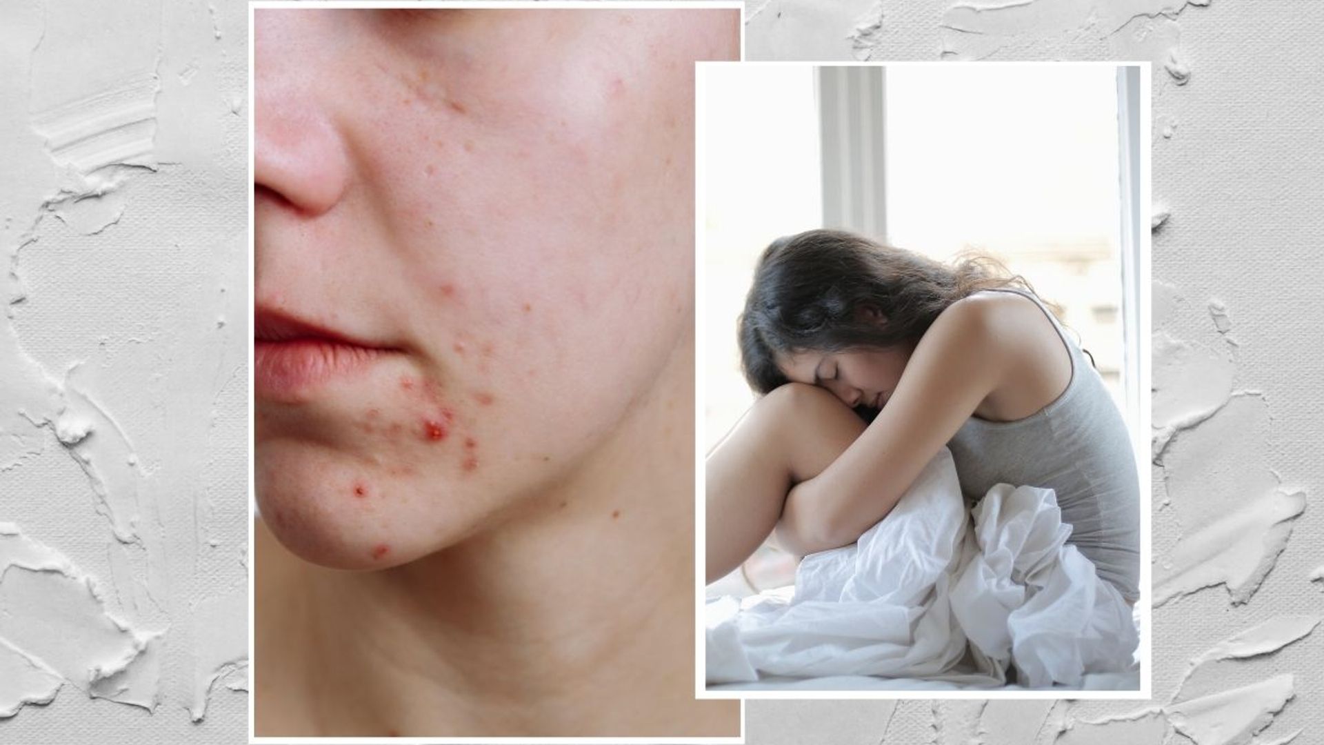 stress and skin acne