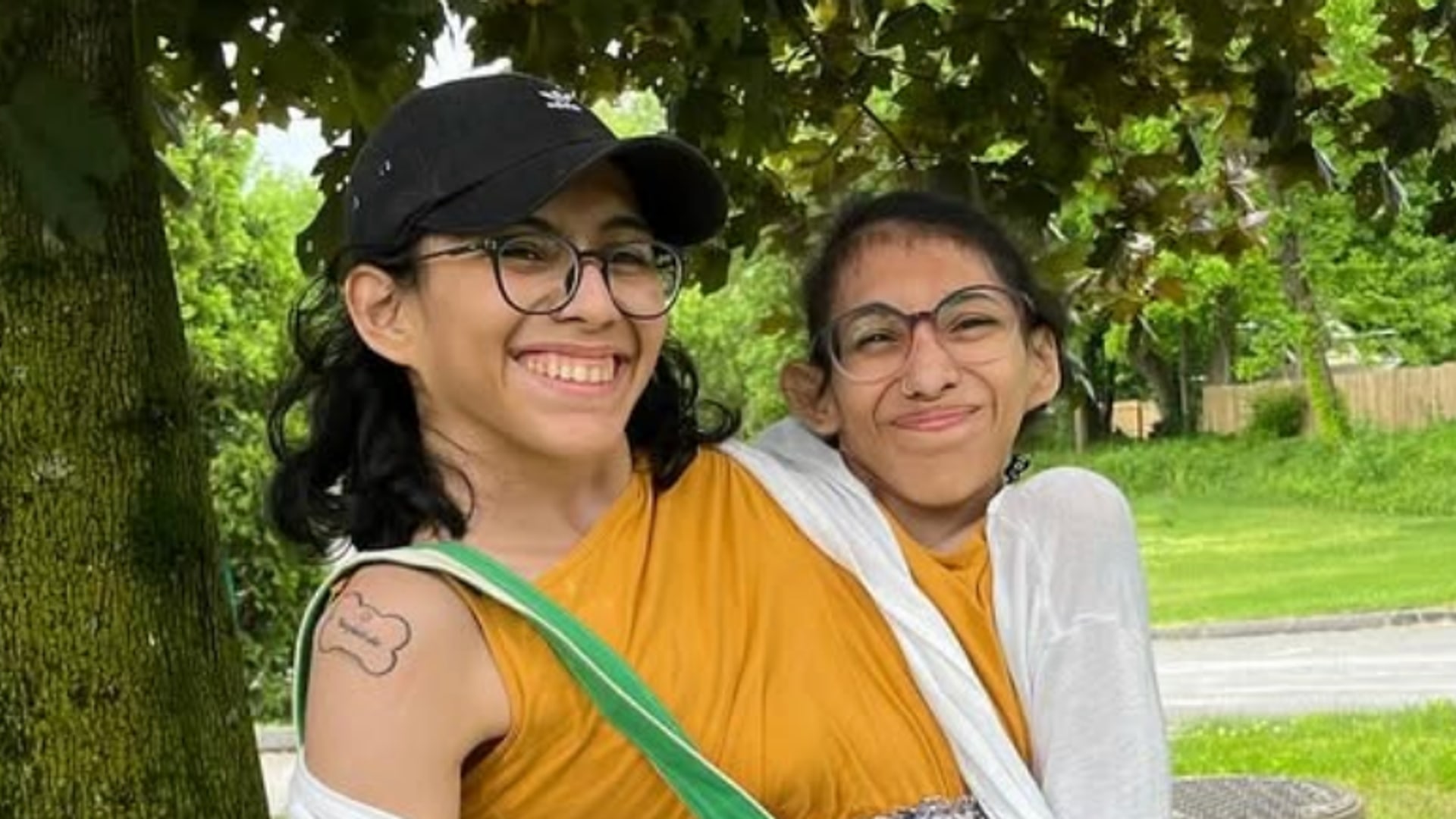 Conjoined twins Carmen and Lupita Andrade