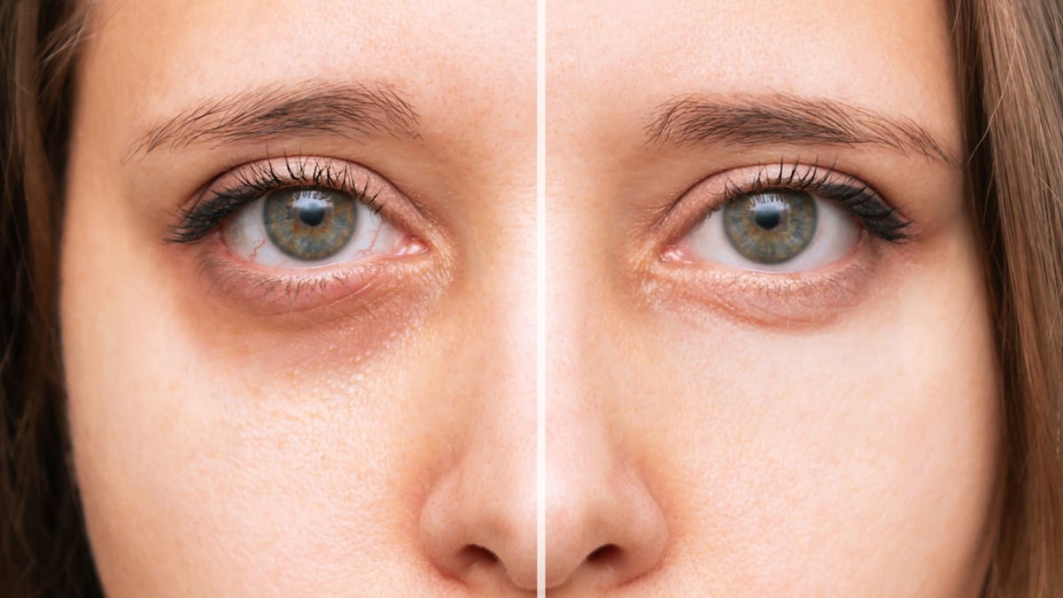 Why you really have dark circles: An expert explains the 4 types and how to fix them