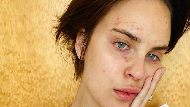 tallulah willis photo of skin picking disorder