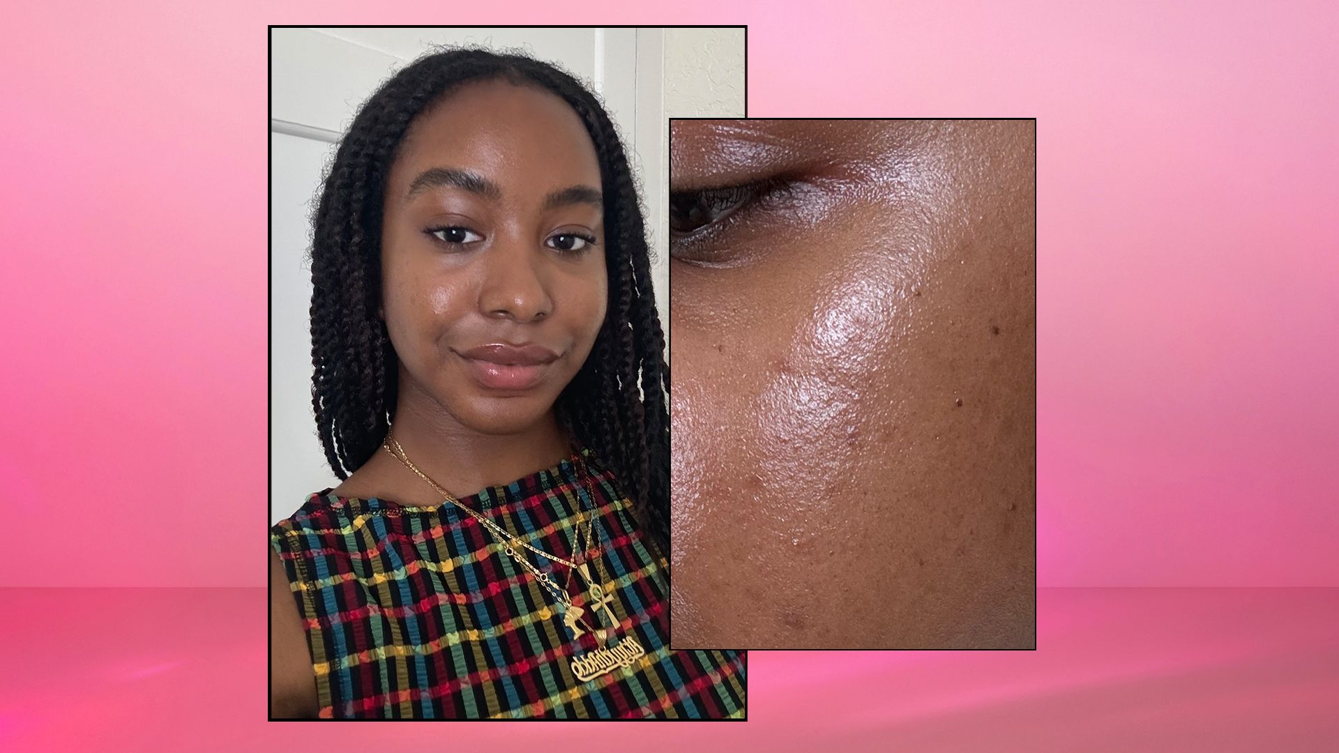 Everyone is getting their 'black girl freckles' removed - but I love mine