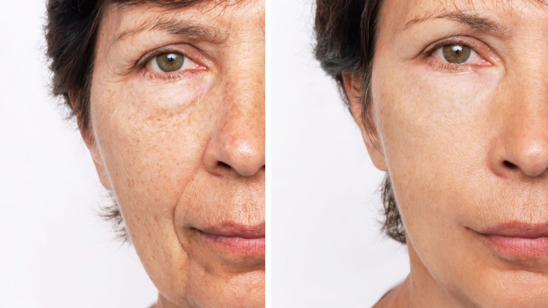 antiageing aesthetic treatment before an after example