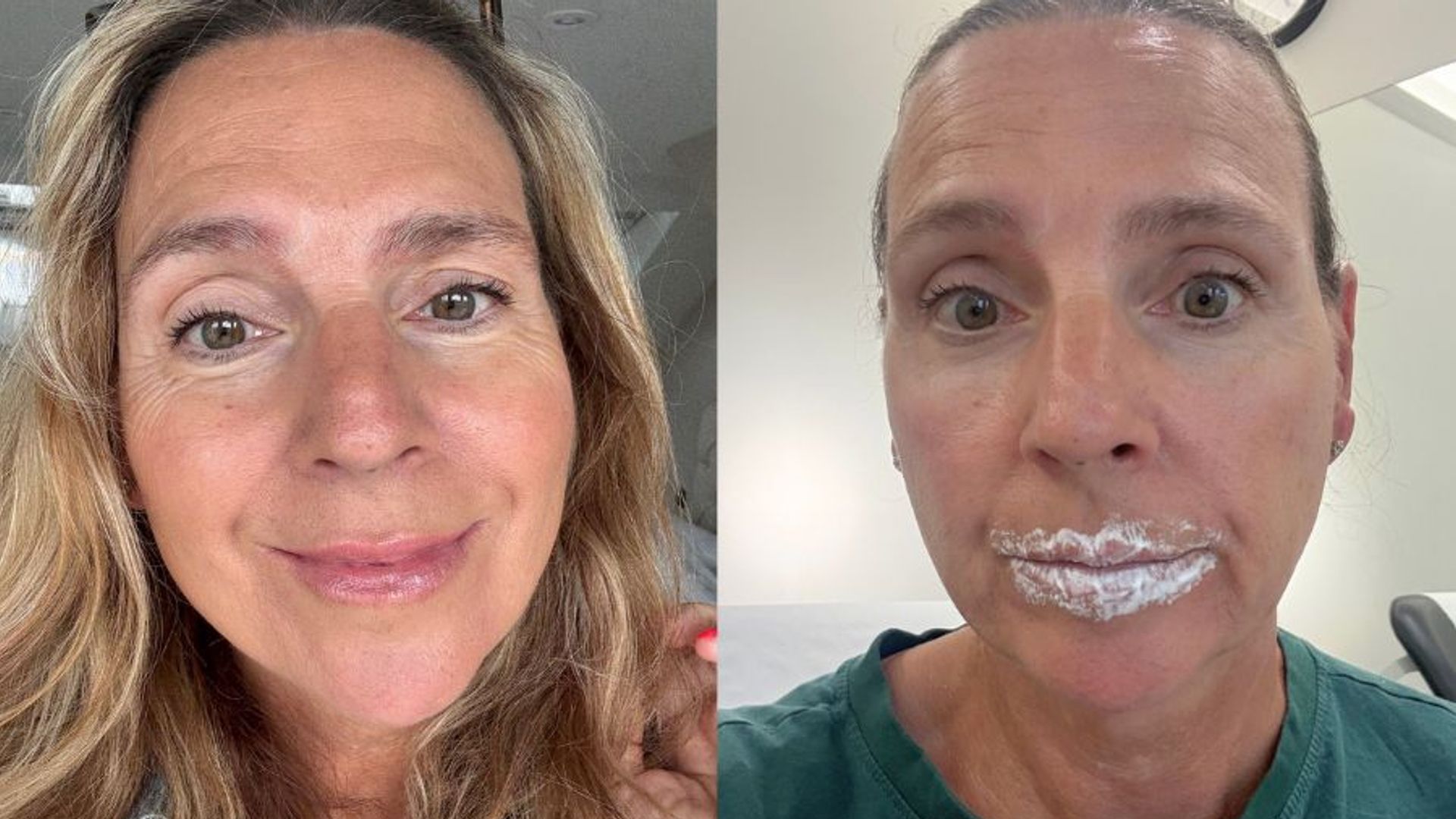 side by side of a woman before and after her lip filler