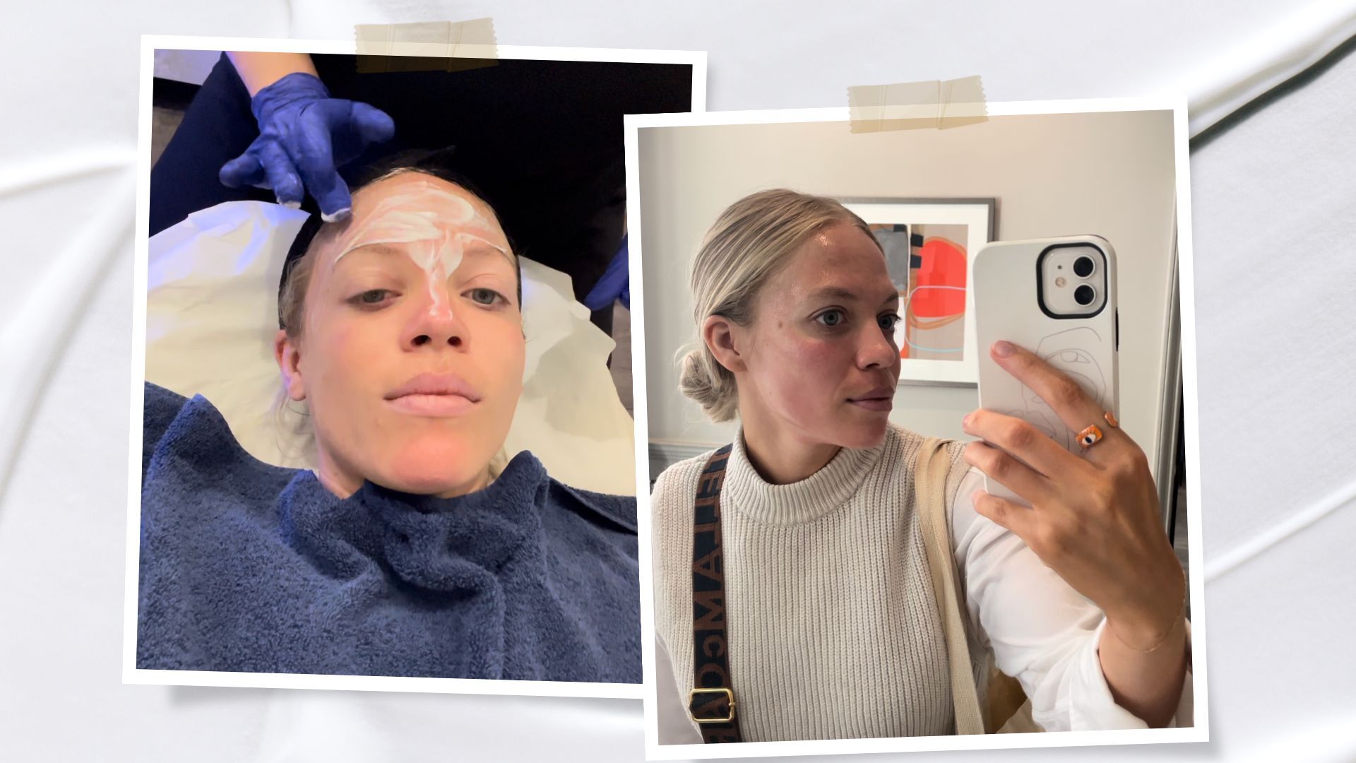 I tried Victoria Beckham-approved microneedling