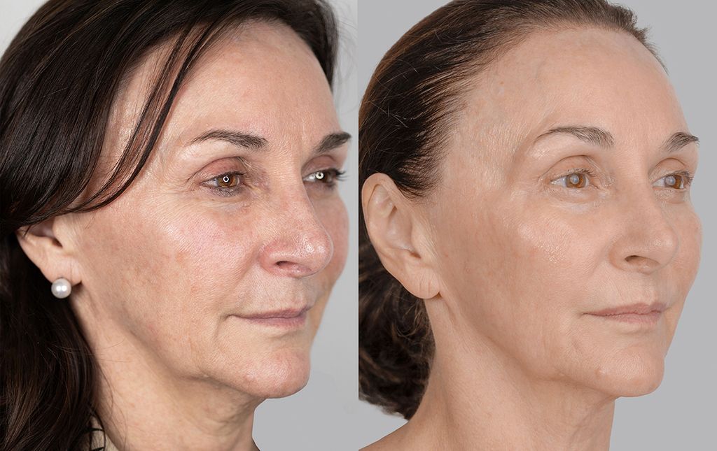 Shirley Ballas before and after photos of non-surgical facelift