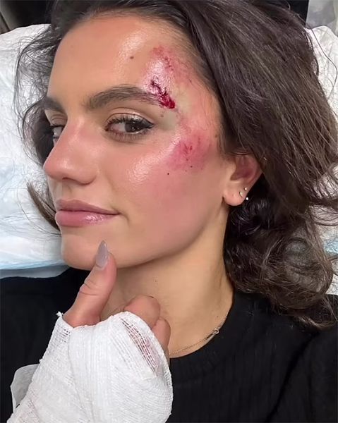 hayley erbert bruised face after car accident