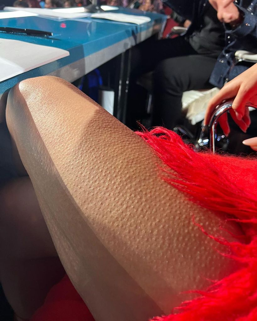Katy Perry's leg covered in goosebumps