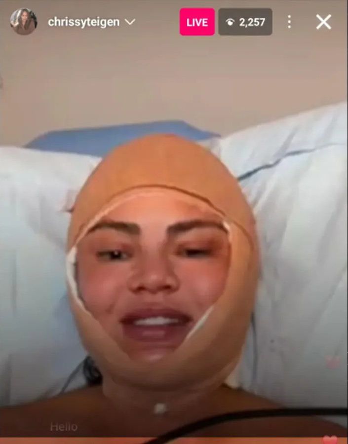 photo of chrissy teigen with face wrapped in bandage