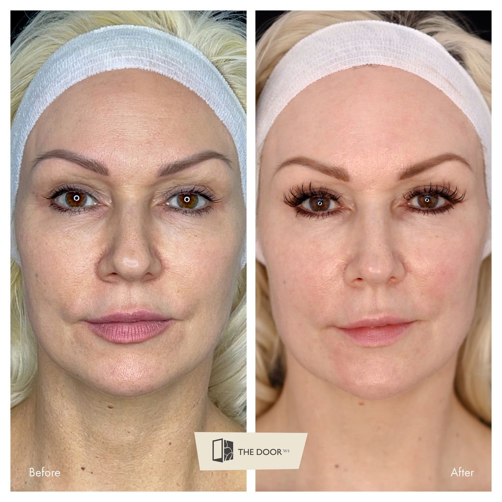 Kristina Rihanoff before and after of her skin treatment