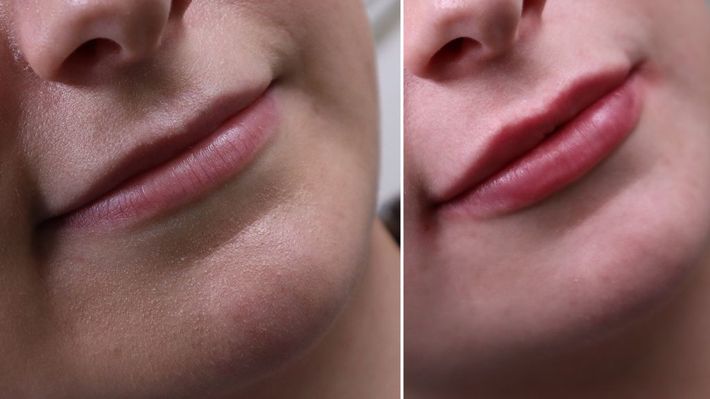 before and after lip filler 