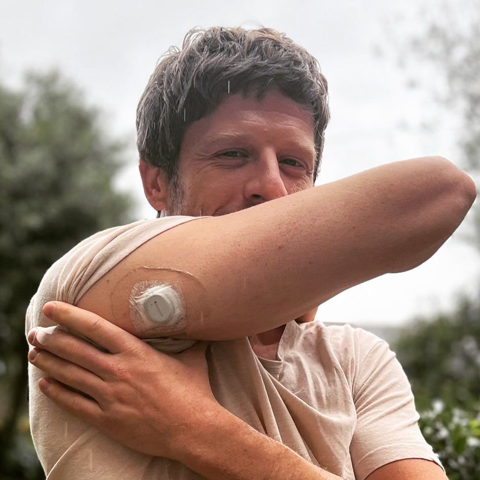 James Norton with his implant for diabetes