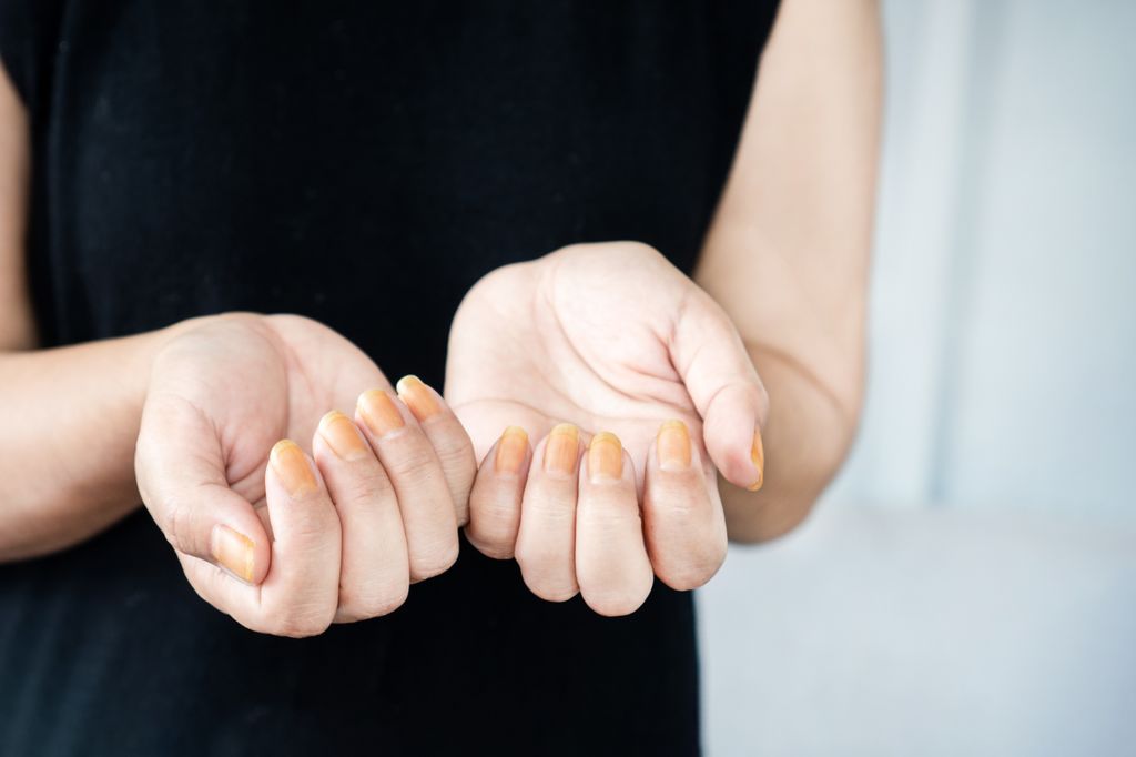 Closeup,Woman,Showing,Yellow,Nail,Fungus 