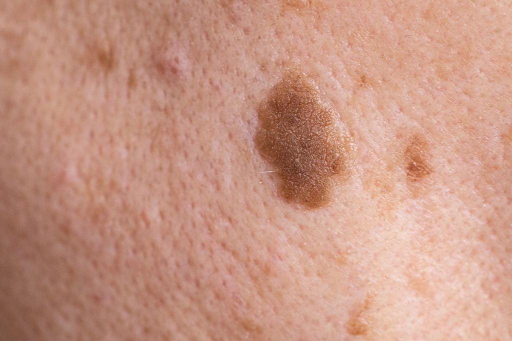 A mole on the skin