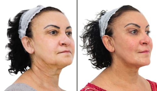 Before and after aesthetic treatment