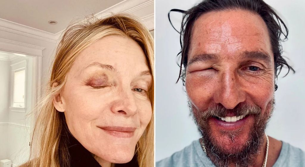 Michelle Pfieffer and Matthew McConaughey both share eye injuries