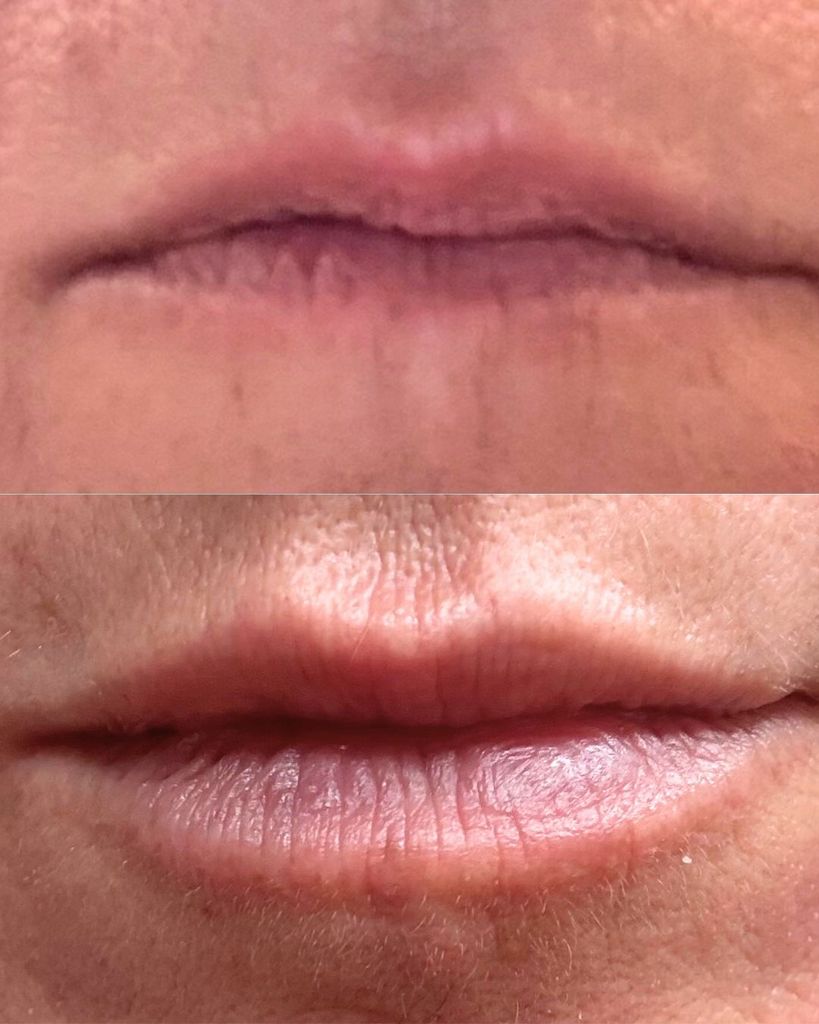 before and after photo of lip filler 