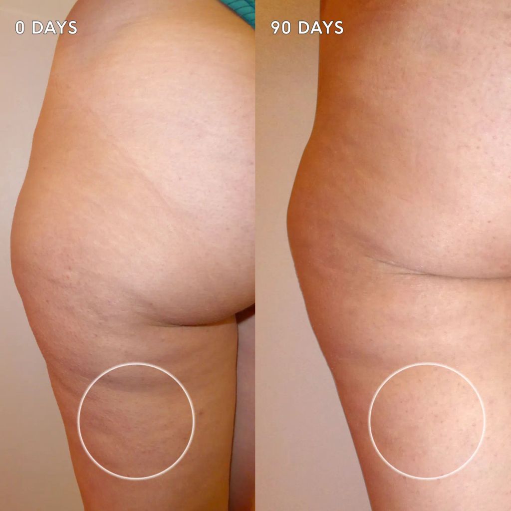 cellulite supplements