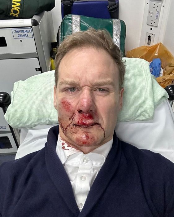 Dan Walker bloodied and bruised after bike accident 