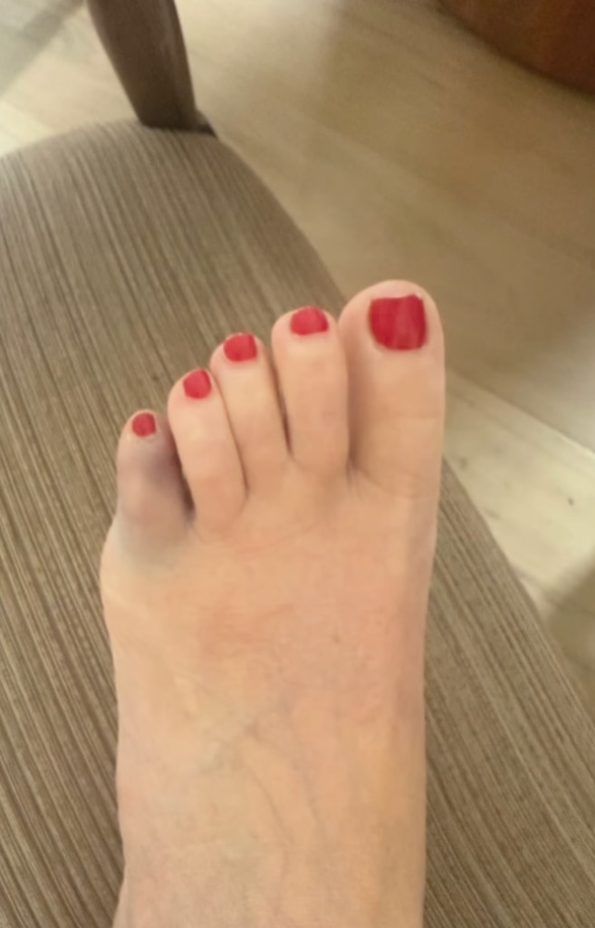 Savannah's pinky toe was black and blue