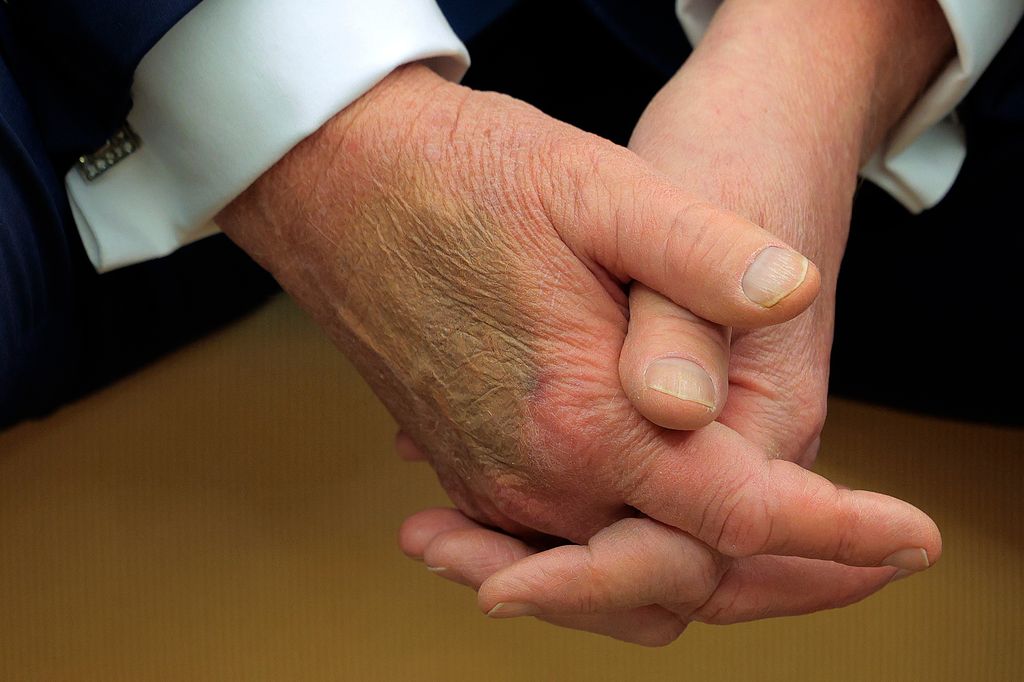 Makeup covers a bruise on the back of U.S. President Donald Trump's hand as he hosts French President Emmanuel Macron for meetings at the White House on February 24, 2025 in Washington, DC