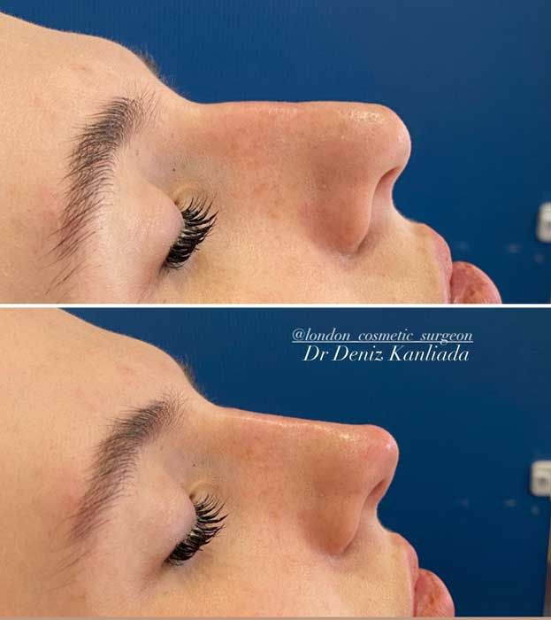 non surgical nose job before after