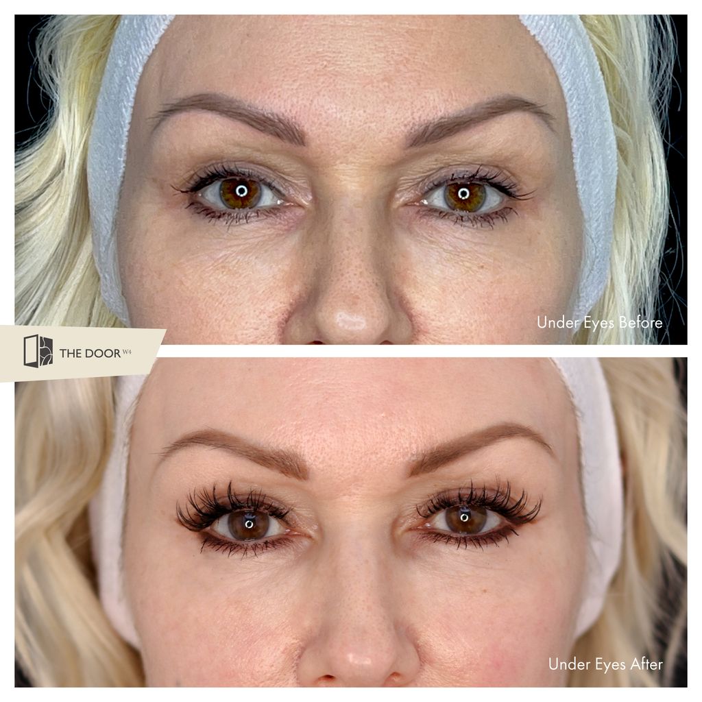 Before and after photos of Kristina Rihanoff's under eyes