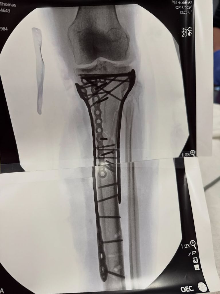 Lindsey Vonn réagit au fait d'avoir été qualifiée d'« égoïste » pour avoir participé aux Jeux olympiques d'hiver : « Cela a piqué » 3 Lindsey Vonn partage une photo d'une radiographie de son tibia fracturé après une opération, partagée sur Instagram