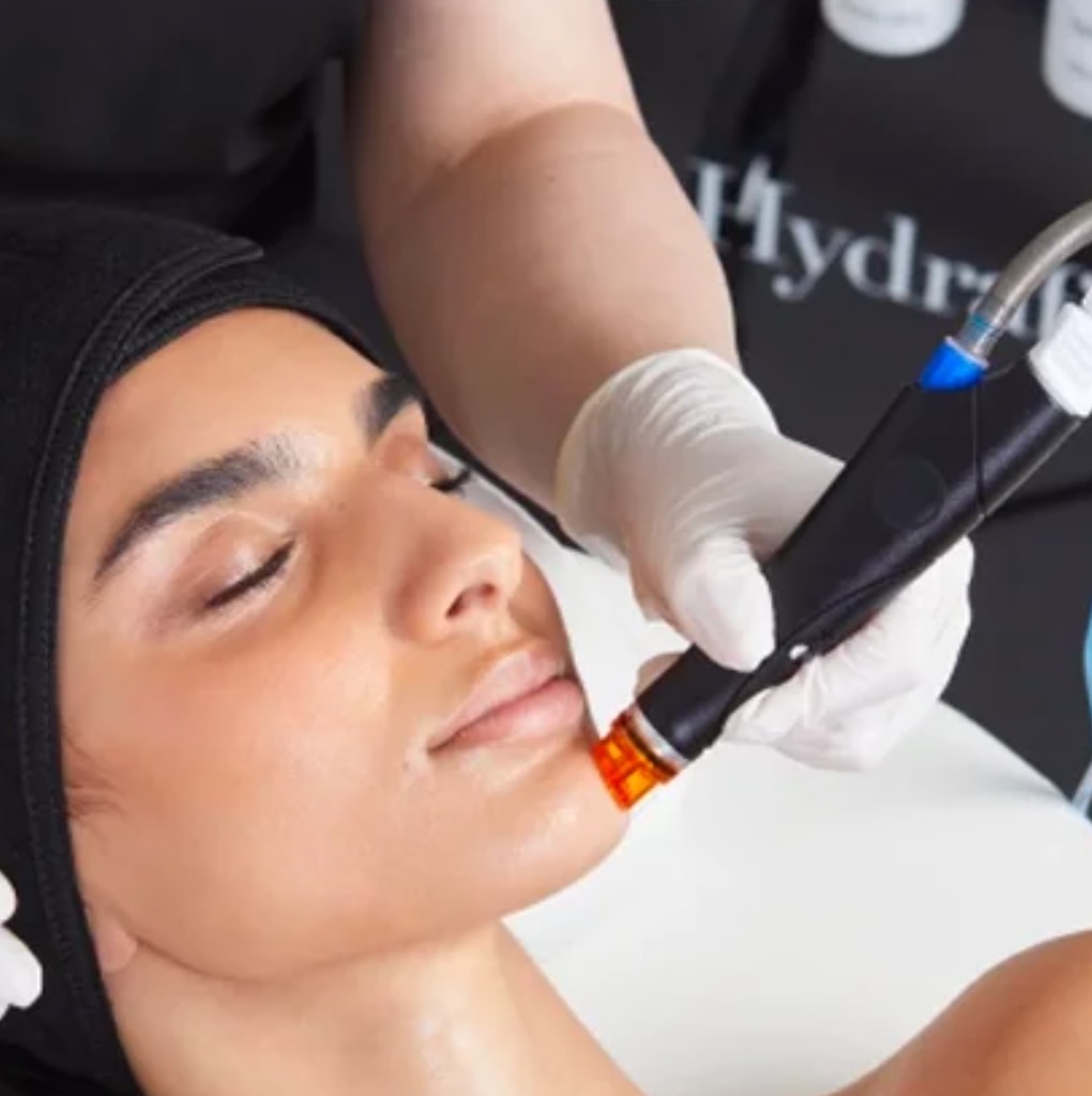 Photo of a woman having nano-needling