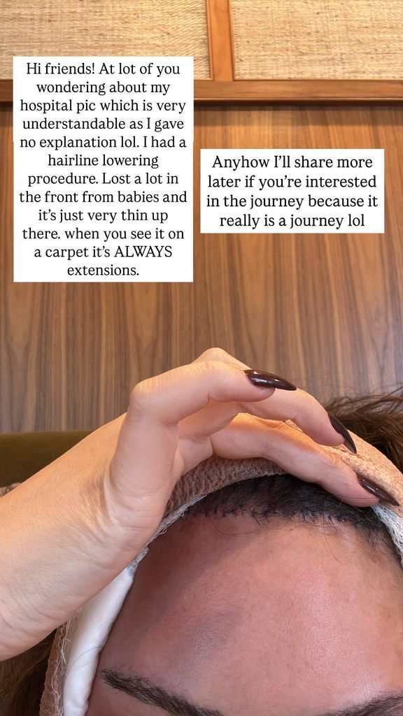 photo of chrissy teigen forehead after hairline lowering procedure