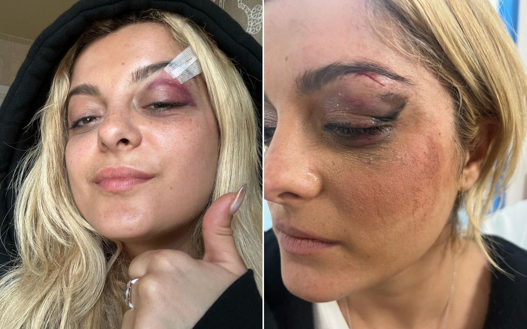 Bebe Rexha's black eye and stitches