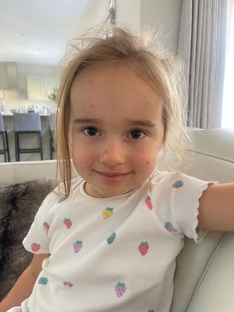 Ola and James' daughter, Ella, had the chicken pox recently