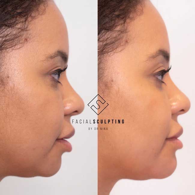 jaw filler before after