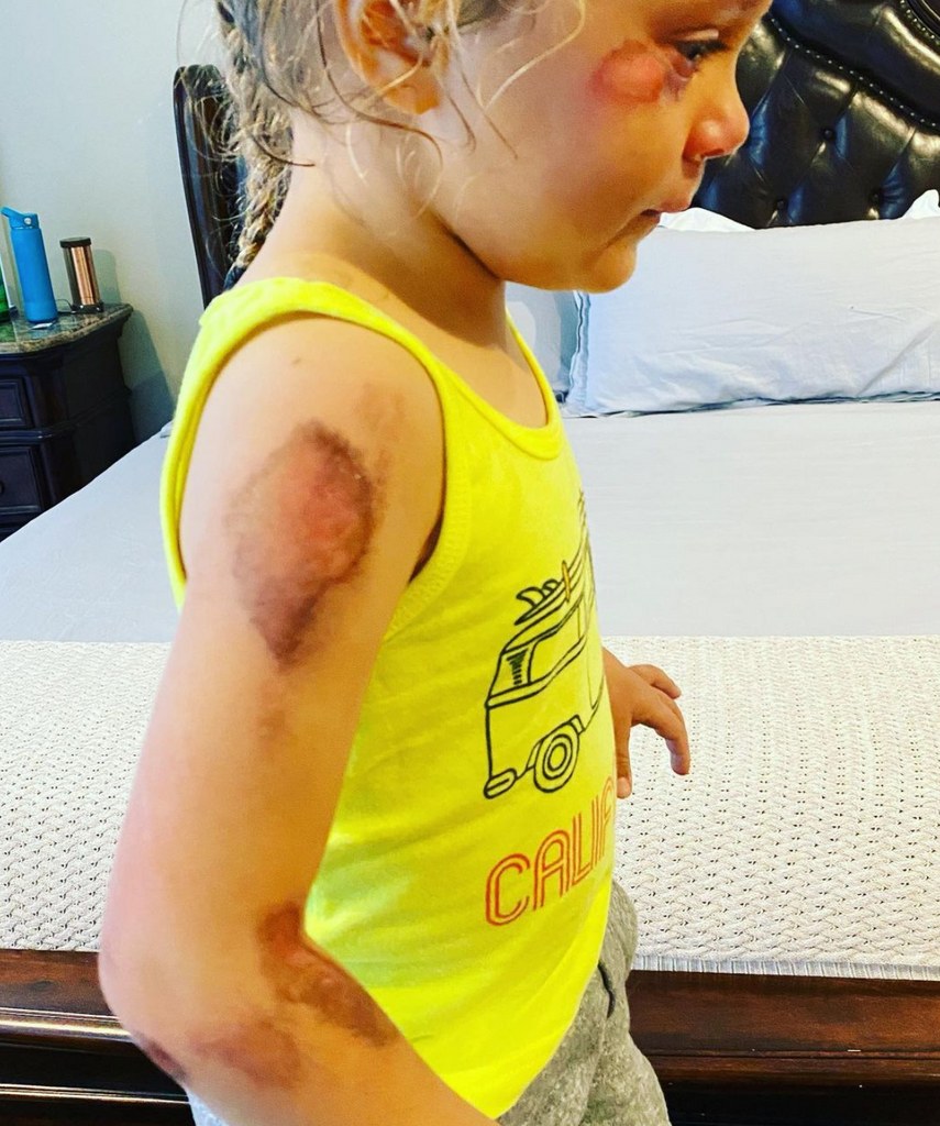 Photo posted by Alfonso Ribeiro on Instagram May 12, 2023, of his four-year-old daughter Ava Sue and her injuries following a scooter accident 