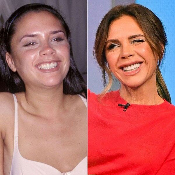 victoria beckham teeth before after