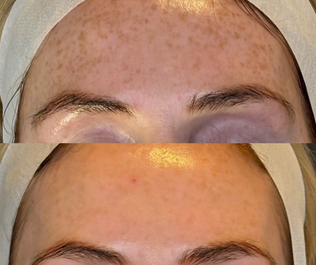 I couldn't believe the results Shantel shared of reversing sun damage on clients