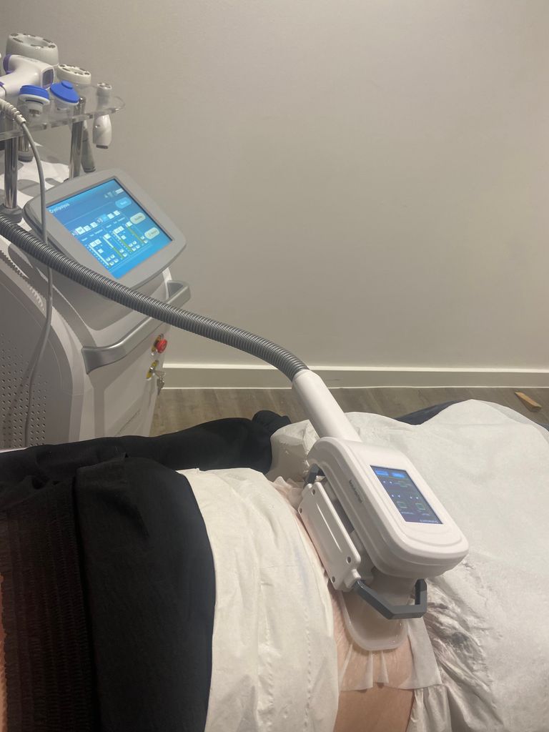 3DLipo fat freezing I got my stomach fat frozen with surprising