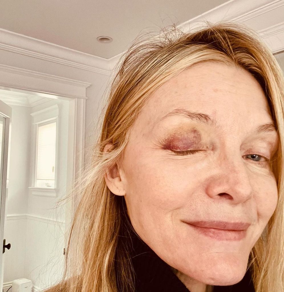 Michelle Pfeiffer revealed her black eye