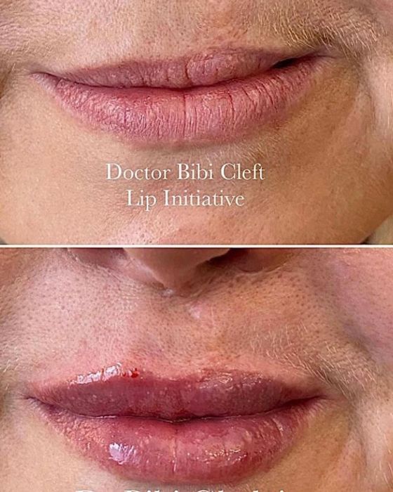 cleft lip before and after surgery