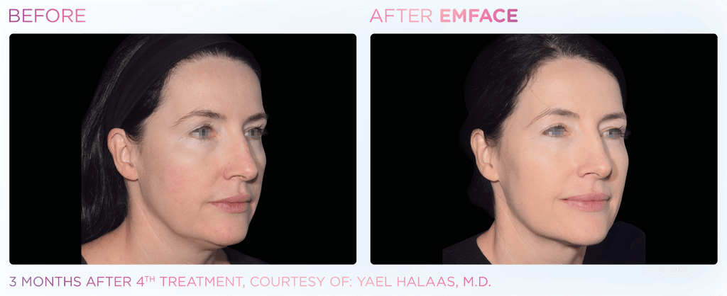 Emface before and after