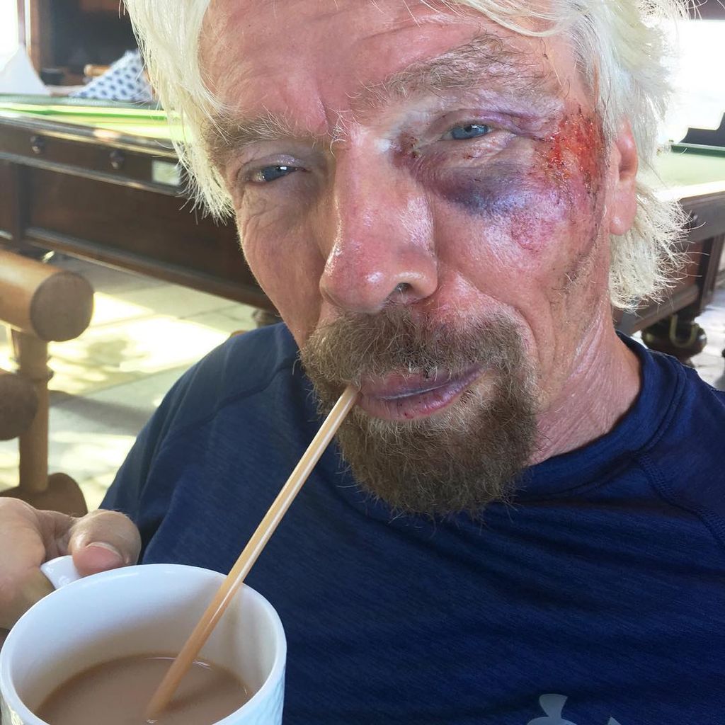 Richard Branson sipping tea with facial bruises 