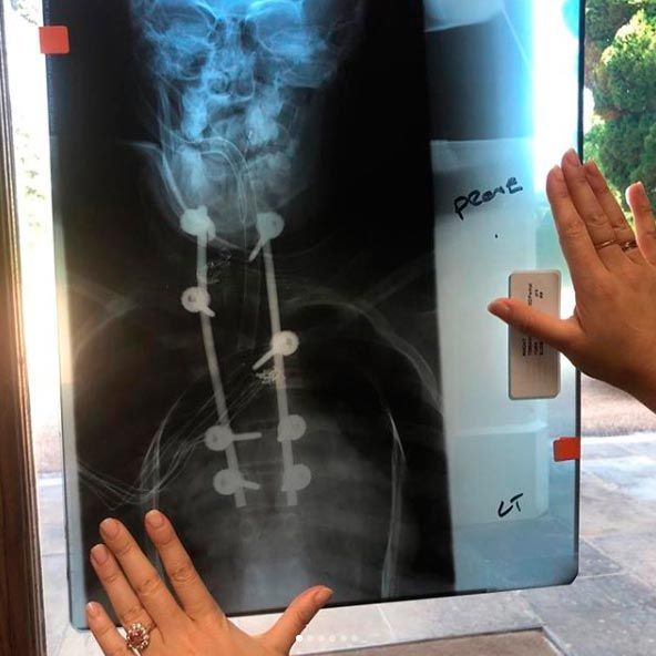 princess eugenie spine x ray
