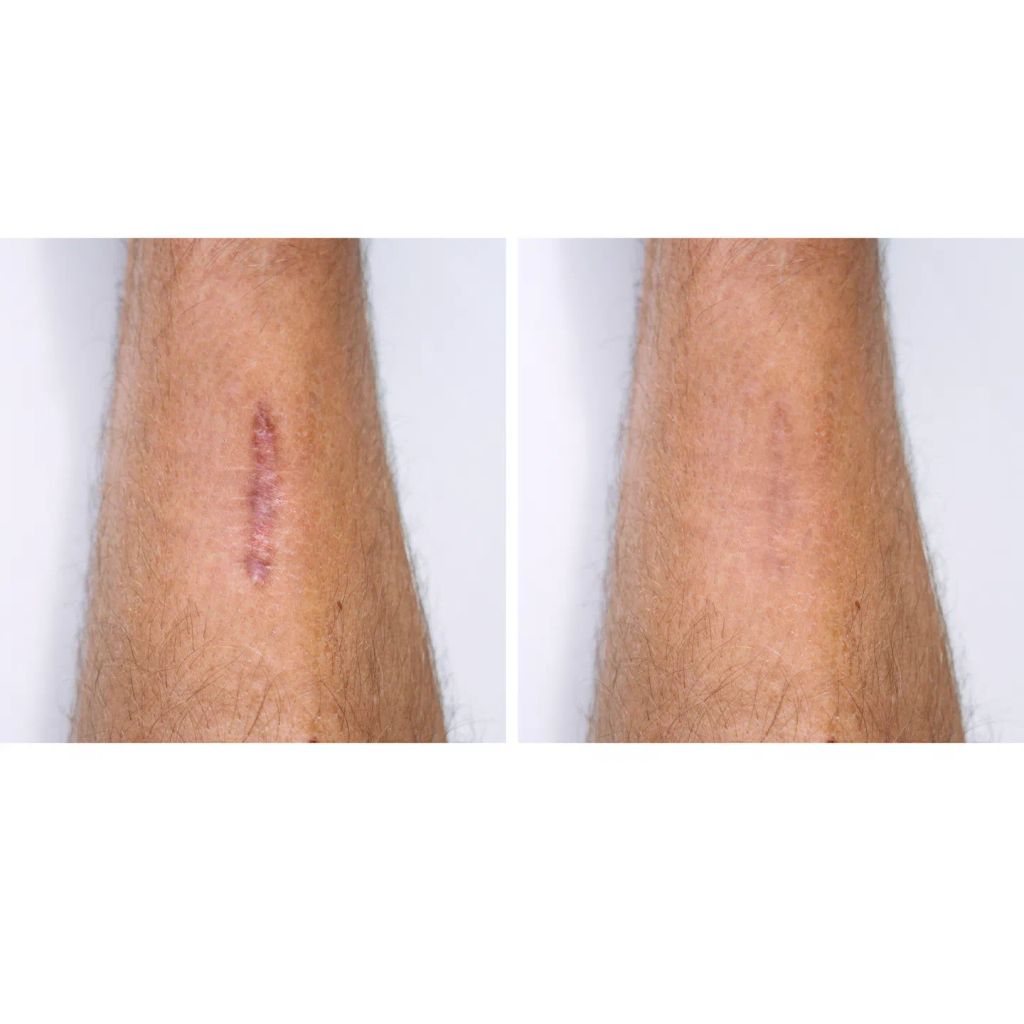 scar erase Silicone Scar Removal Sheets