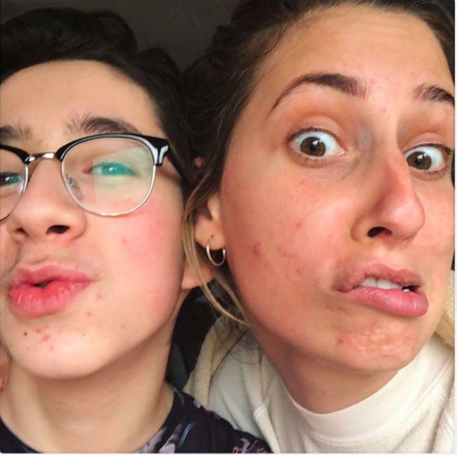 stacey solomon acne makeup free