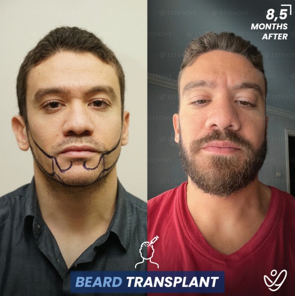 Before and after of beard hair transplant