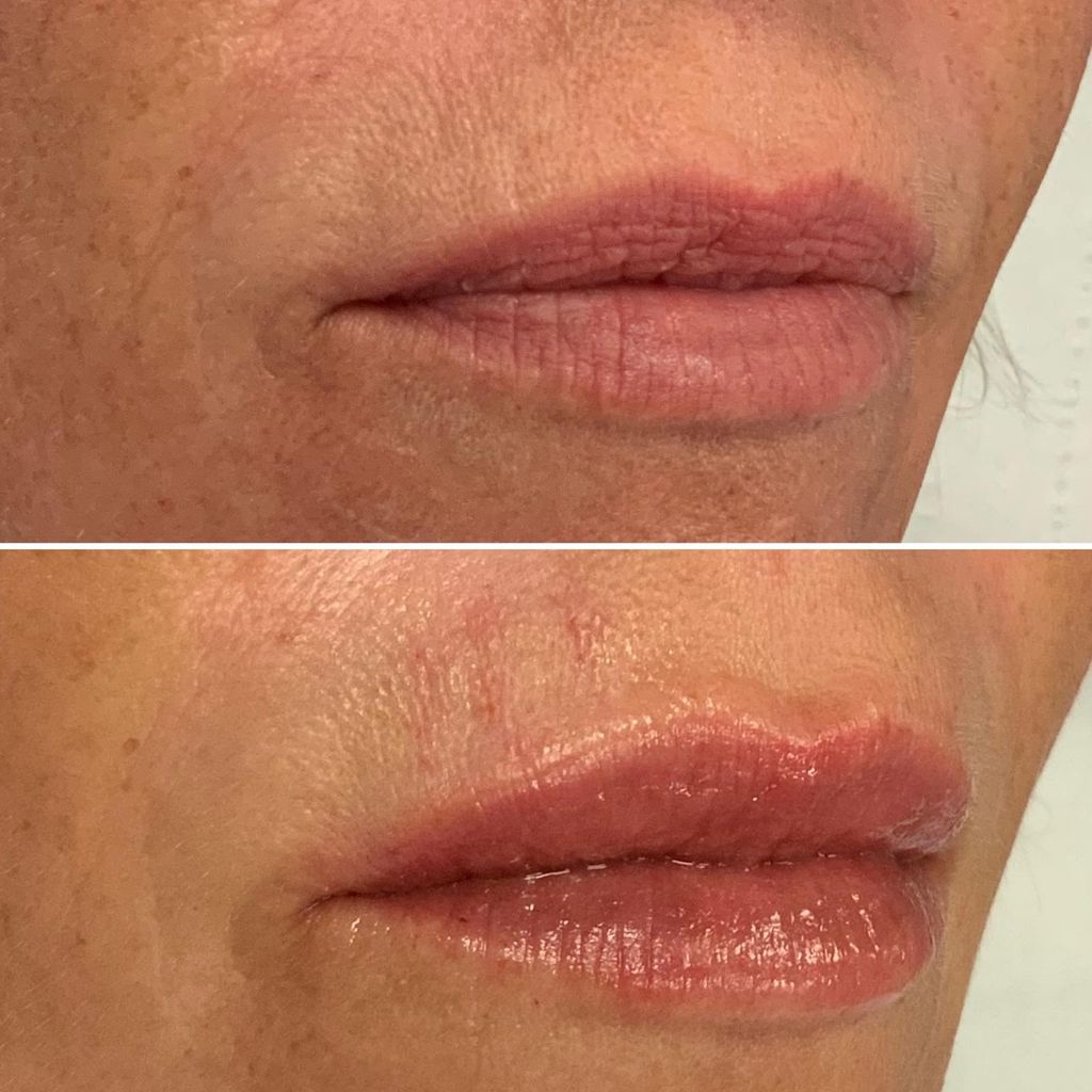 before and after photo of lips before and after lip filler