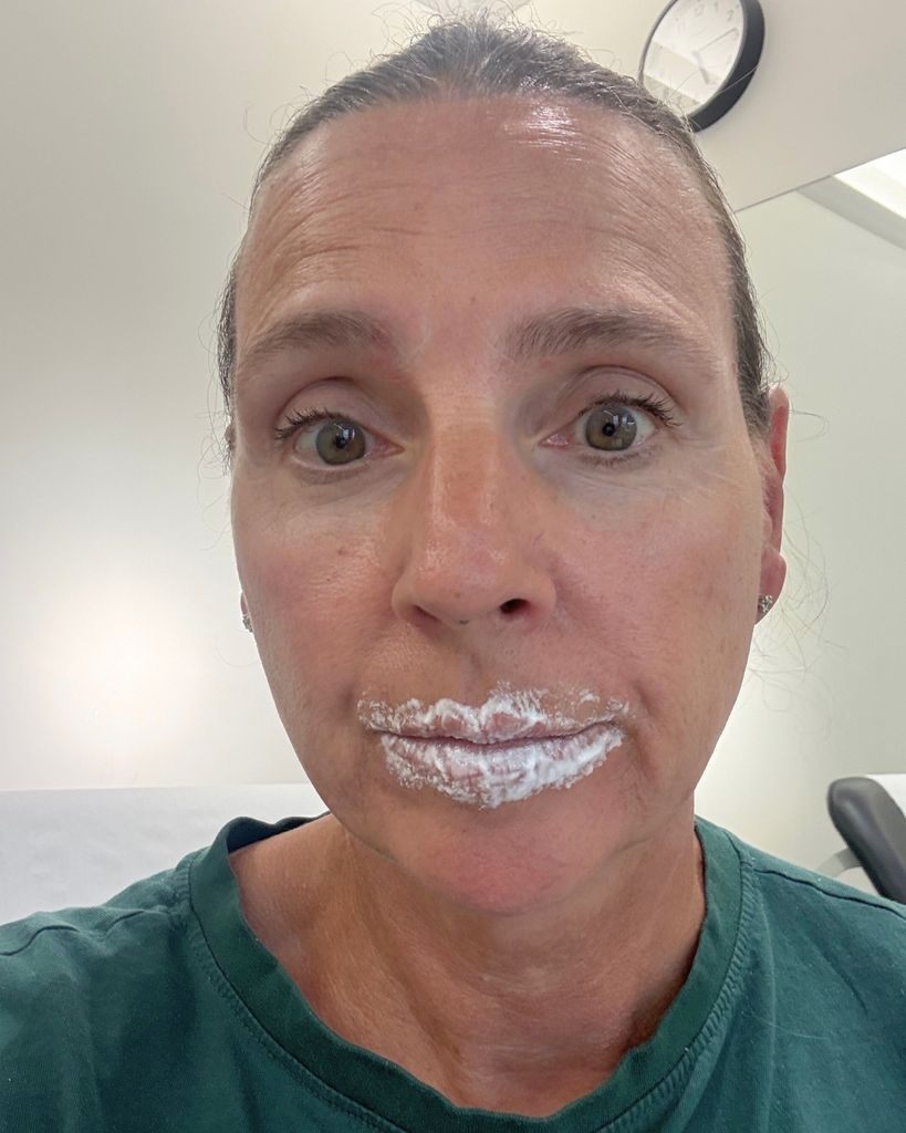 woman with white cream on her lips to numb them before lip filler