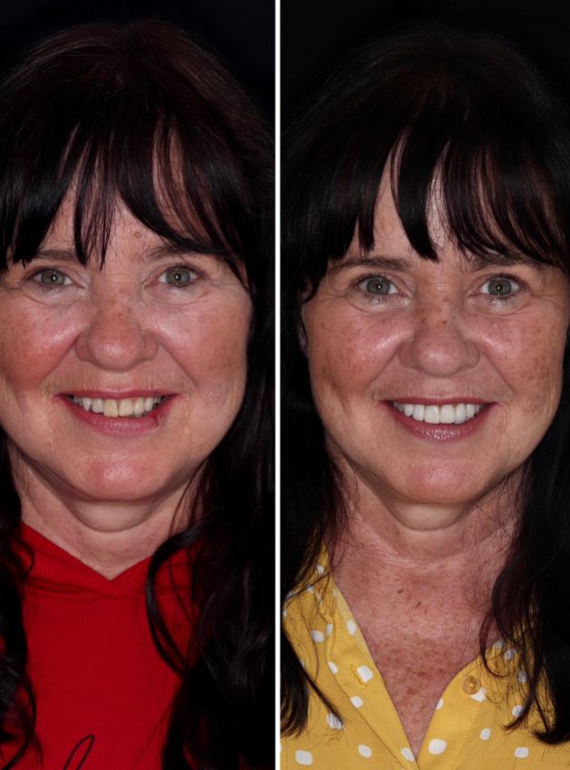A before and after photo of Coleen Nolan, one with yellow teeth and the other with white