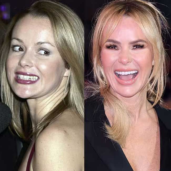 black celebrities with bad teeth before and after